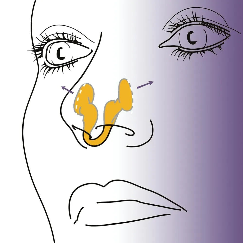 BARESY nasal dilator illustration showing yellow nasal inserts opening nostrils anti-snoring device
