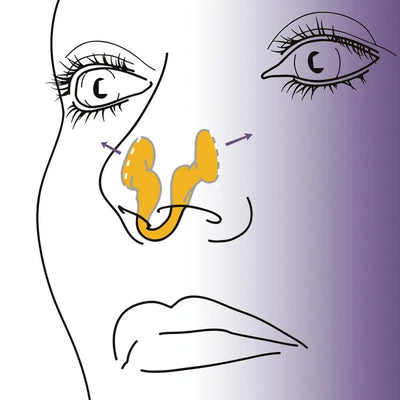 BARESY nasal dilator illustration showing yellow nasal inserts opening nostrils anti-snoring device